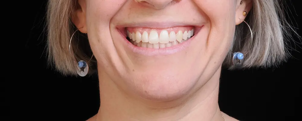 Cas 05, le sourire obtenu après traitement