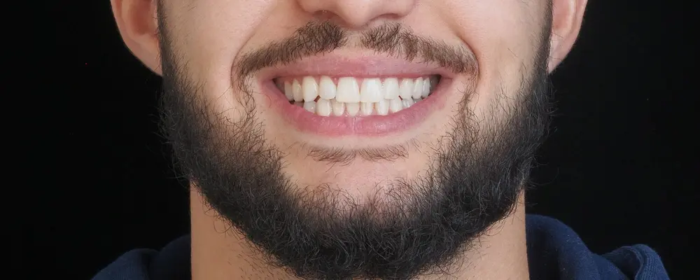 Cas 06, le sourire obtenu après traitement