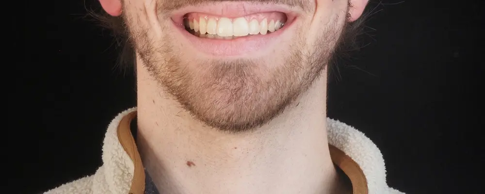 Cas 03, le sourire obtenu après traitement