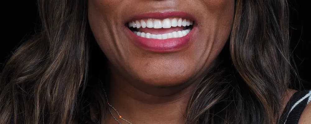 Cas 01, le sourire obtenu après traitement